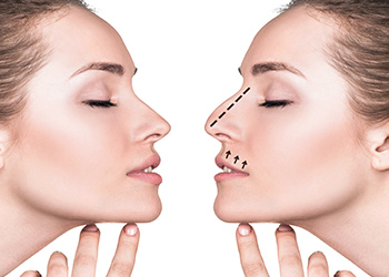 rhinoplasty-before-and-after-brisbane