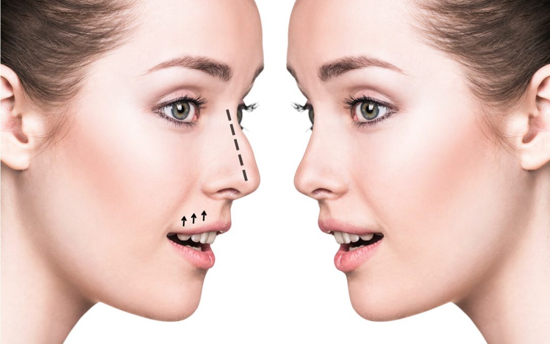 How To Achieve The Perfect Nose (Rhinoplasty Surgery)