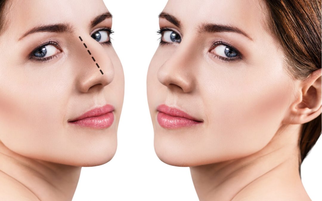 How To Get The Perfect Nose Job: What Should Be Done?