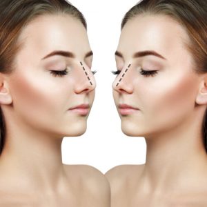 perfect nose job