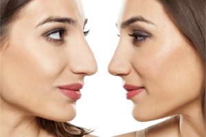 Before and after rhinoplasty surgery