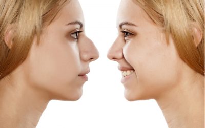 Do I Need A Nose Job? Things To Know Before A Rhinoplasty