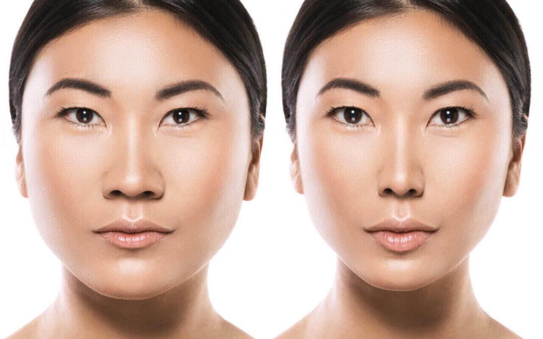Asian Rhinoplasty: What’s In Store In This Variation Of Surgery?